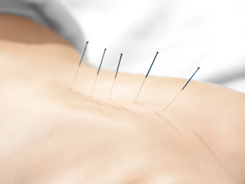 Acupuncture at Bluebonnet Chiropractic in Denver