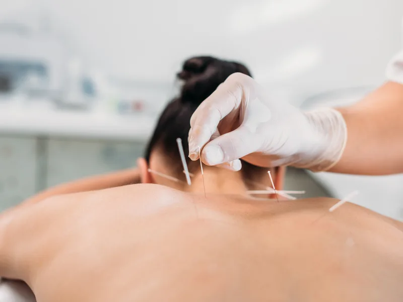Dry Needling at Bluebonnet Chiropractic in Denver